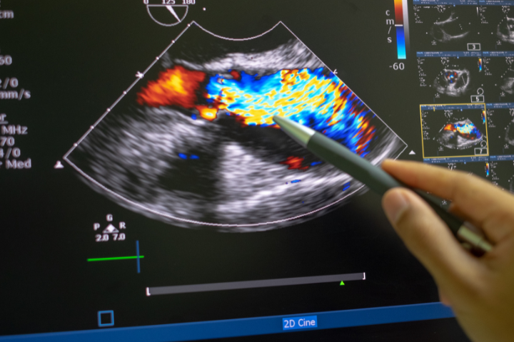 Programa Avanzado en Ecografía Doppler Vascular